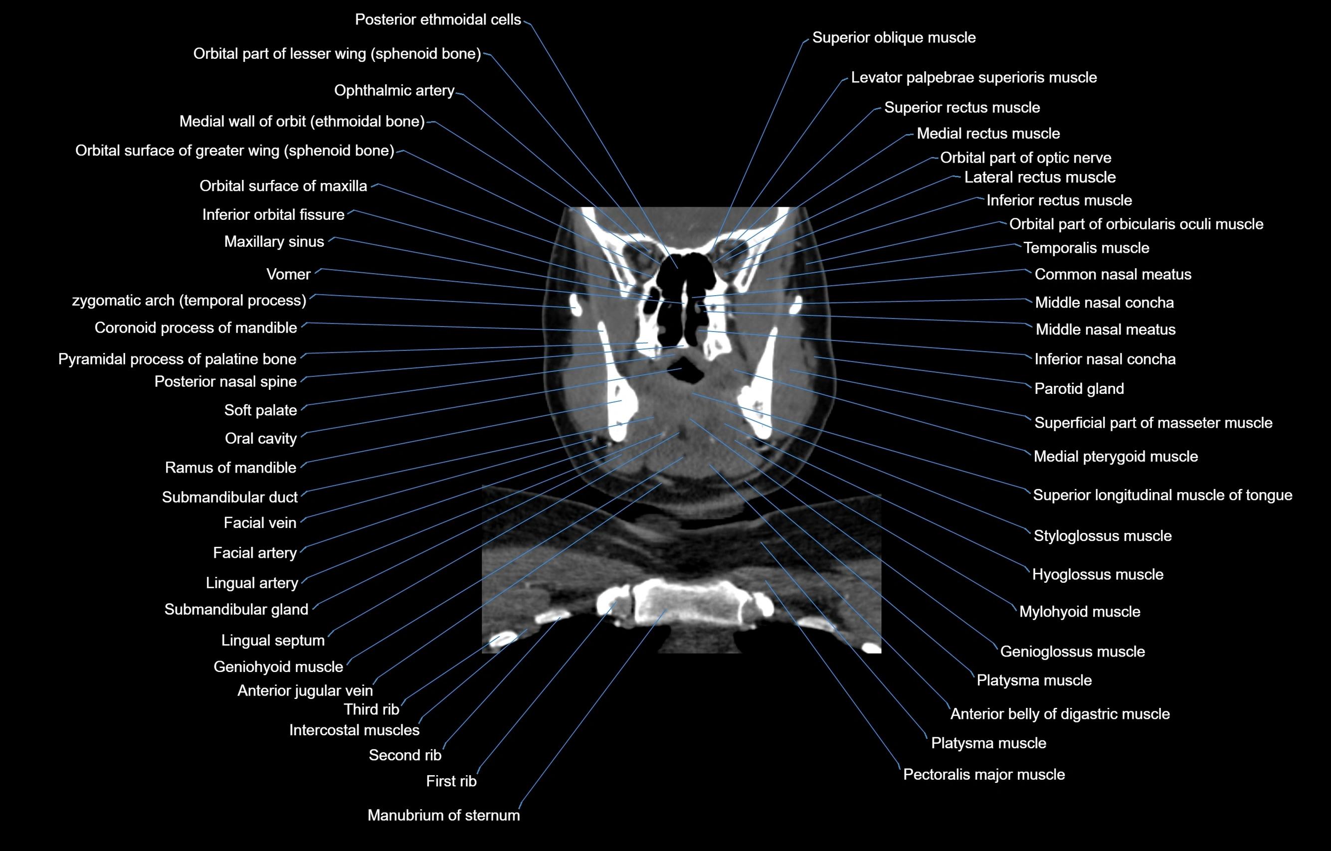 CT Neck coronal  cross sectional anatomy labelled 3D  radiology  image-00023.webp